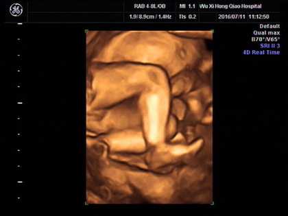 生殖中心代孕产子,是不是女宝宝四维比较不容易配合，四维女宝宝特征有哪些