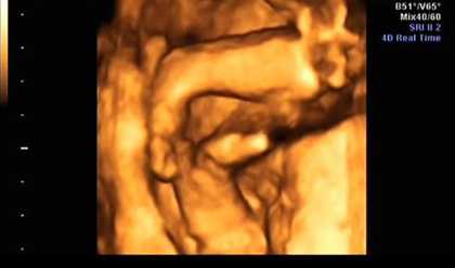 生殖中心代孕产子,是不是女宝宝四维比较不容易配合，四维女宝宝特征有哪些